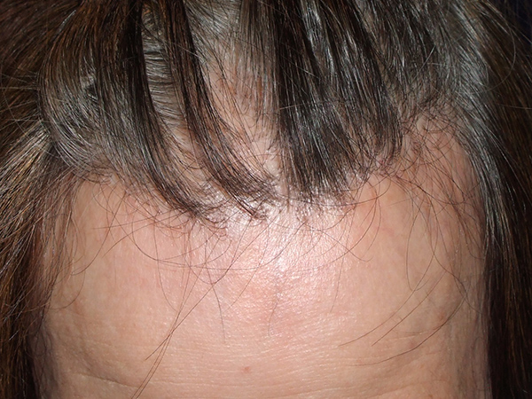 画像：前頭部線維化脱毛症（FFA）：額が後退